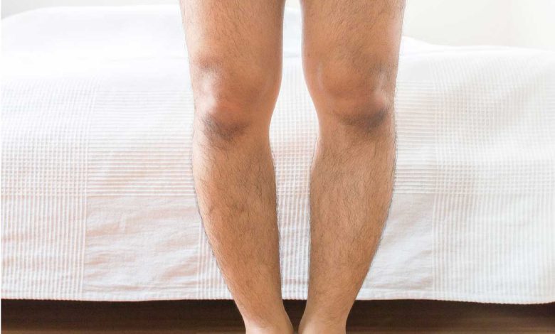تشخيص حنف القدم والعلاج في الوقت المناسب