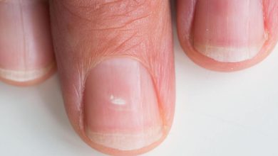 سبب ظهور البقع البيضاء على الأظافر وطرق علاجها