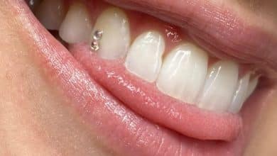ما هو جوهرة الأسنان؟